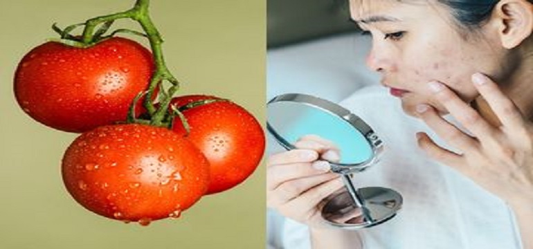 Wajah Jauh dari Jerawat dengan Makan Makanan Berikut