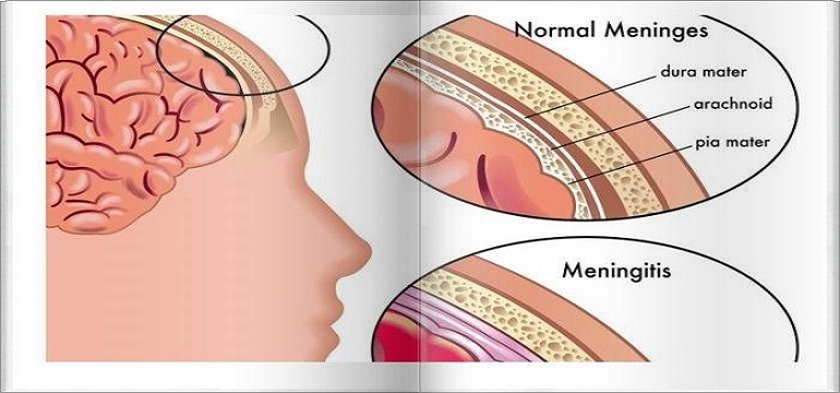 Ini 6 Kebiasaan Buruk yang Meningkatkan Resiko Tertular Penyakit Meningitis
