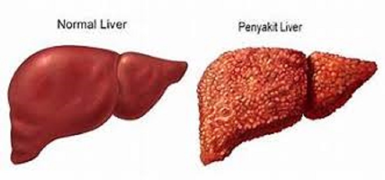 Inilah Penyebab Penyakit Liver dan Kenali Gejalanya
